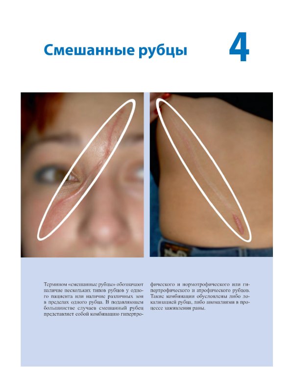 Лечение и коррекция рубцов. Атлас