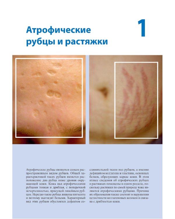 Лечение и коррекция рубцов. Атлас