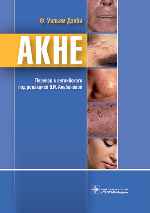 Акне