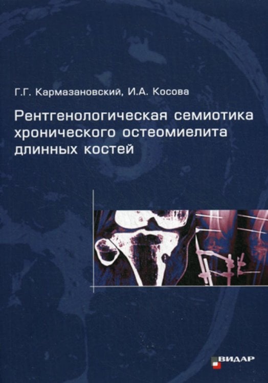 Рентгенологическая семиотика хронического остеомиелита длинных костей