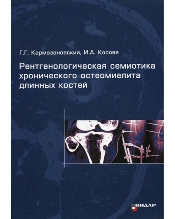 Рентгенологическая семиотика хронического остеомиелита длинных костей