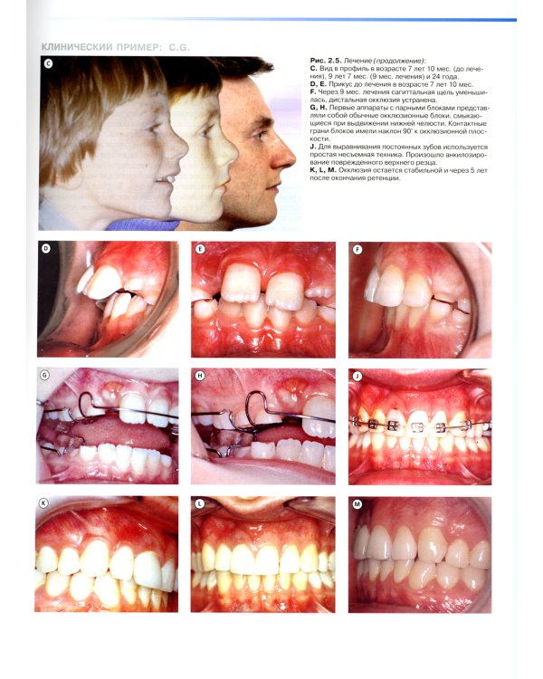 Ортодонтическое лечение парными блоками. 3-е изд