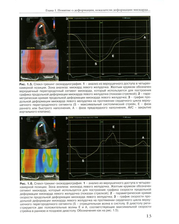 Двухмерная спекл-трекинг-эхокардиография для оценки деформации миокарда и камер сердца: Учебное пособие