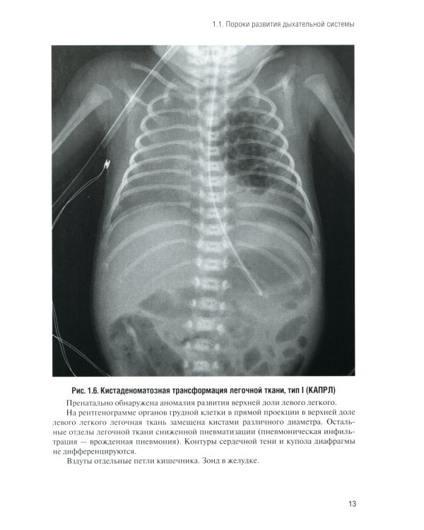 Неотложная рентгенодиагностика в неонатологии и педиатрии (Атлас рентгеновских изображений): Учебное пособие. 2-е изд., доп. и перераб