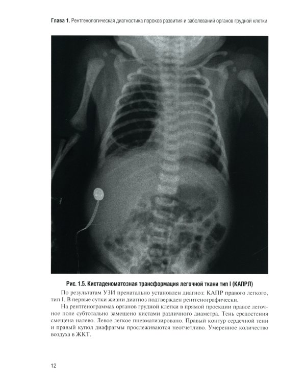 Неотложная рентгенодиагностика в неонатологии и педиатрии (Атлас рентгеновских изображений): Учебное пособие. 2-е изд., доп. и перераб
