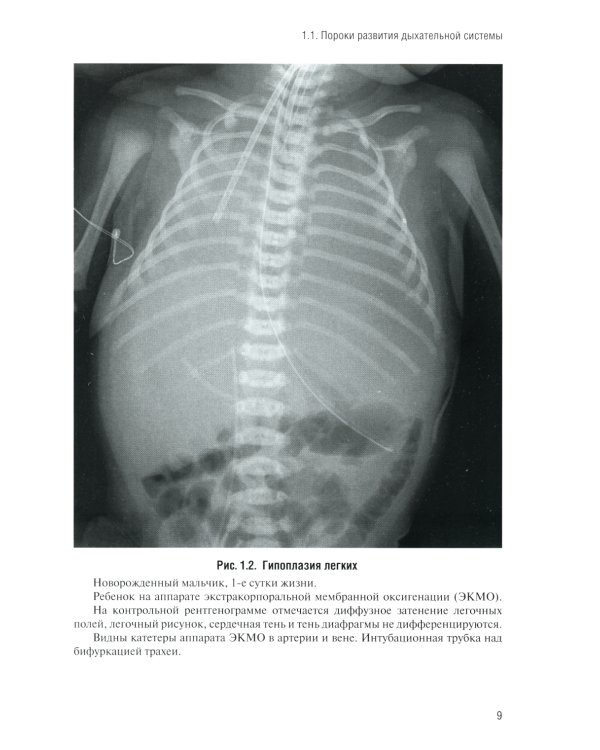 Неотложная рентгенодиагностика в неонатологии и педиатрии (Атлас рентгеновских изображений): Учебное пособие. 2-е изд., доп. и перераб