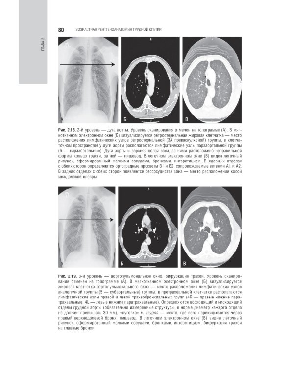 Лучевая диагностика органов грудной клетки: национальное руководство. 2-е изд., перераб. и доп