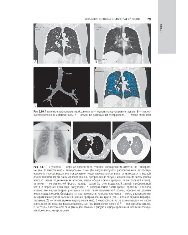 Лучевая диагностика органов грудной клетки: национальное руководство. 2-е изд., перераб. и доп