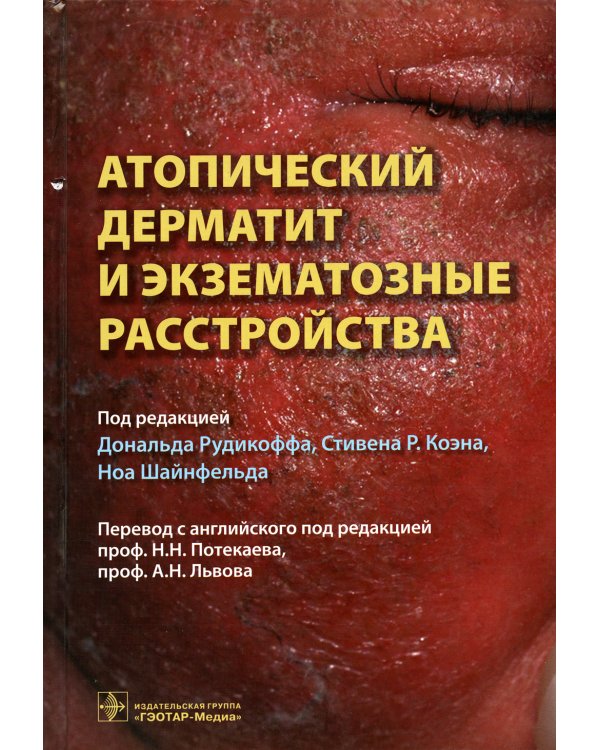 Атопический дерматит и экзематозные расстройства