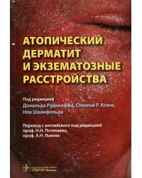 Атопический дерматит и экзематозные расстройства