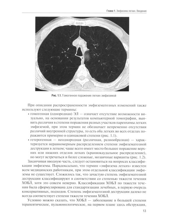 Тяжелая эмфизема легких