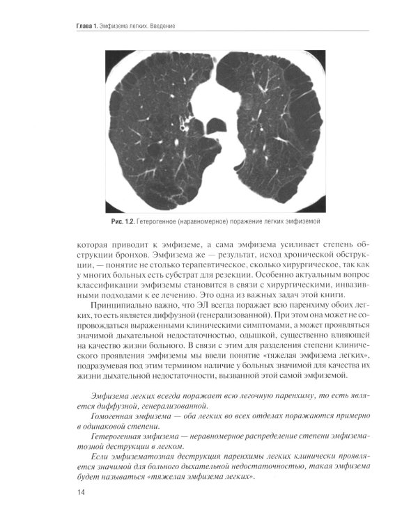 Тяжелая эмфизема легких