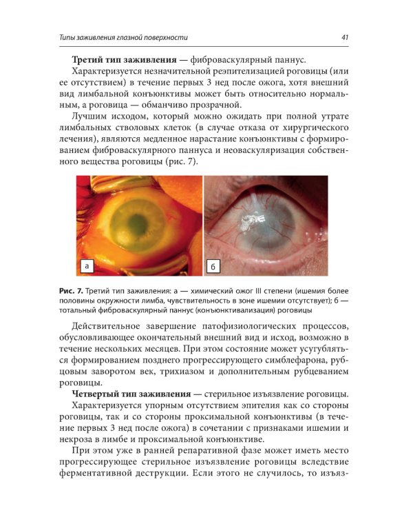 Ожоги глаз. Состояние проблемы и новые подходы. 2-е изд., перераб.и доп