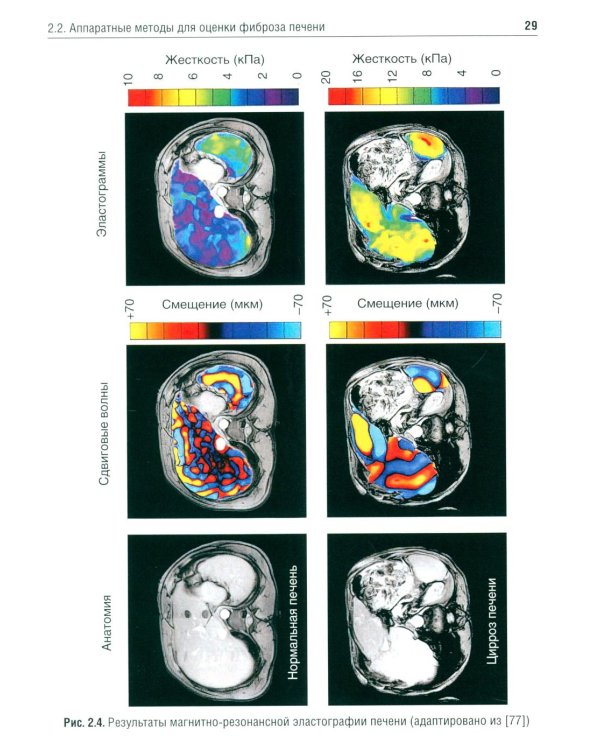 Методы оценки фиброза печени в клинической практике: Учебное пособие