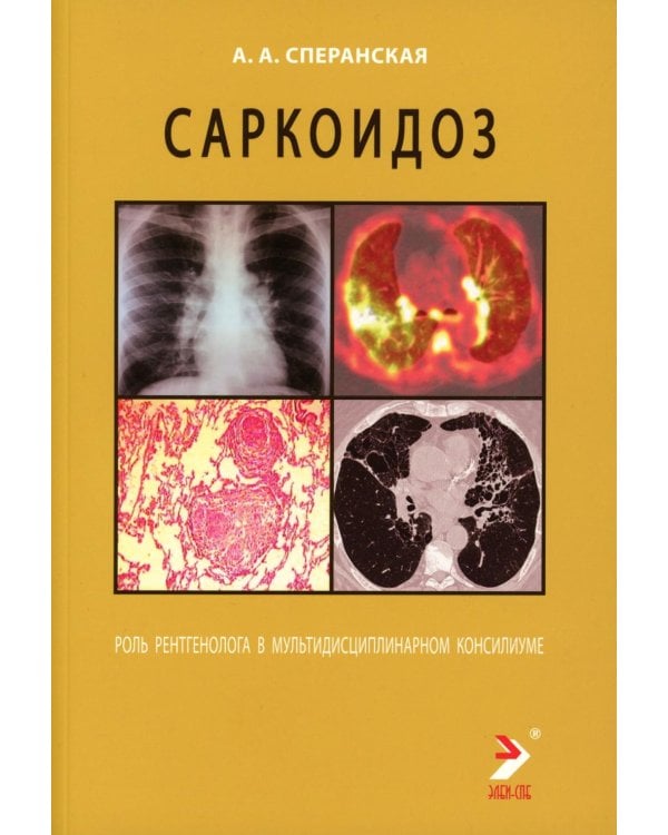 Саркоидоз. Роль ренгенолога в мультидисциплинарном консилиуме