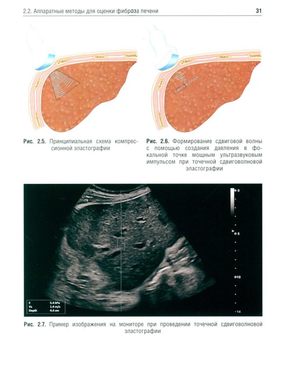 Методы оценки фиброза печени в клинической практике: Учебное пособие