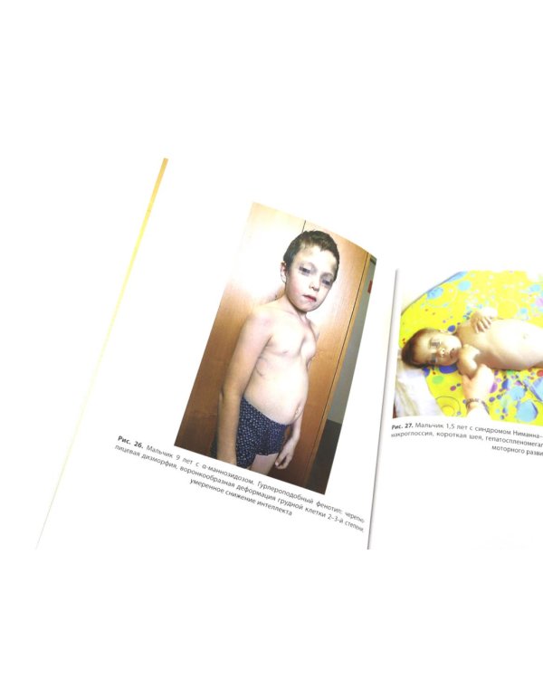 Мукополисахаридозы у детей: дифференциальная диагностика и лечение: Учебное пособие для врачей