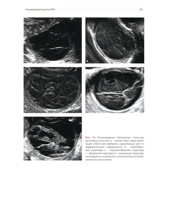 Стандартизация ультразвукового исследования патологии придатков матки по IOTA, O-RADS. Методические рекомендации. 4-е изд