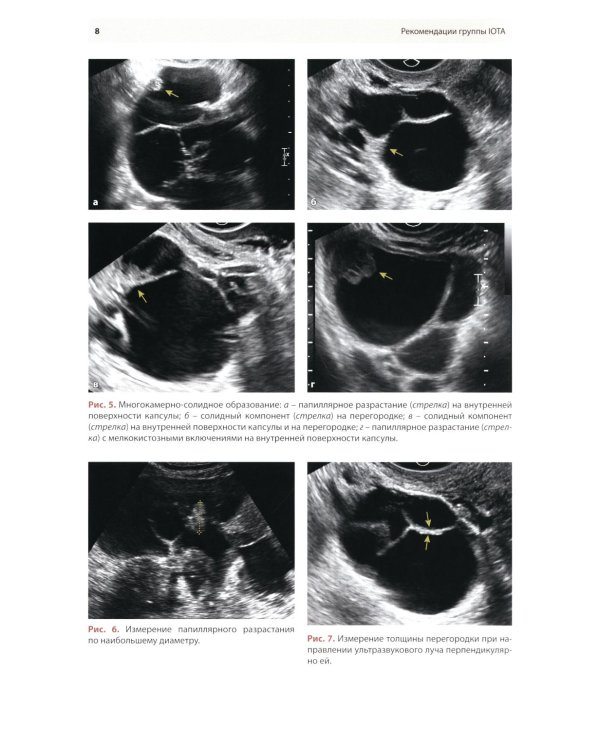 Стандартизация ультразвукового исследования патологии придатков матки по IOTA, O-RADS. Методические рекомендации. 4-е изд