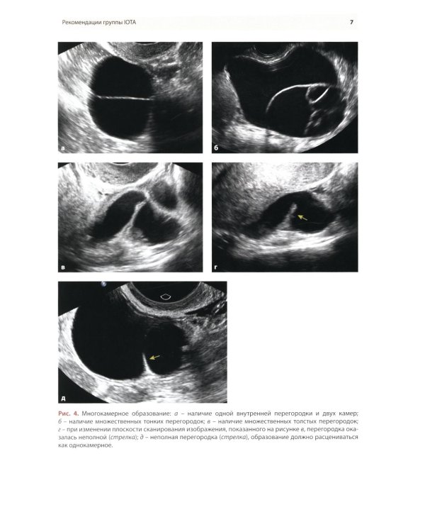 Стандартизация ультразвукового исследования патологии придатков матки по IOTA, O-RADS. Методические рекомендации. 4-е изд