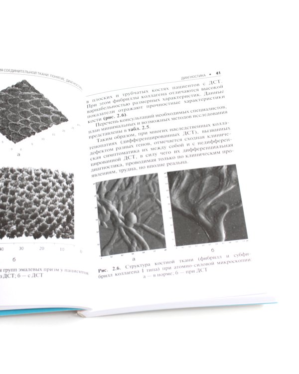 Дисплазия соединительной ткани. 2-е изд., испр. и доп