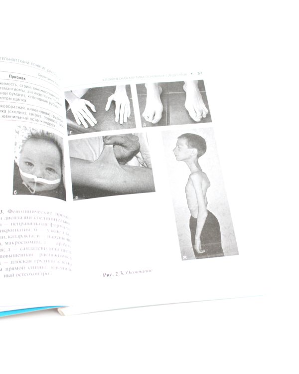 Дисплазия соединительной ткани. 2-е изд., испр. и доп