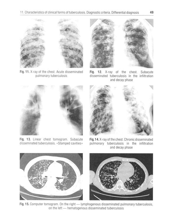Diagnosis and prevention of tuberculosis in general medical practice = Диагностика и профилактика туберкулеза в общей врачебной практике