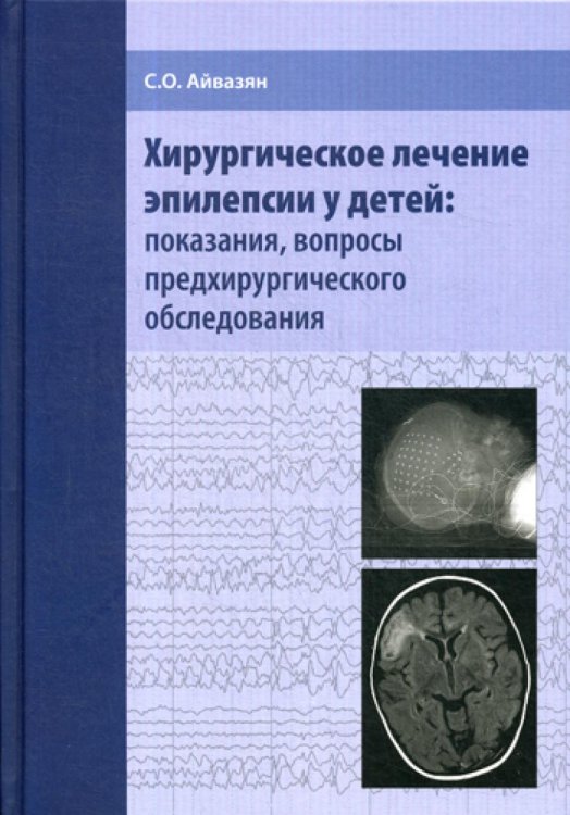 Хирургическое лечение эпилепсии у детей: показания, вопросы предхирургического обследования Хирургическое лечение эпилепсии у детей: показания, вопросы предхирургического обследования