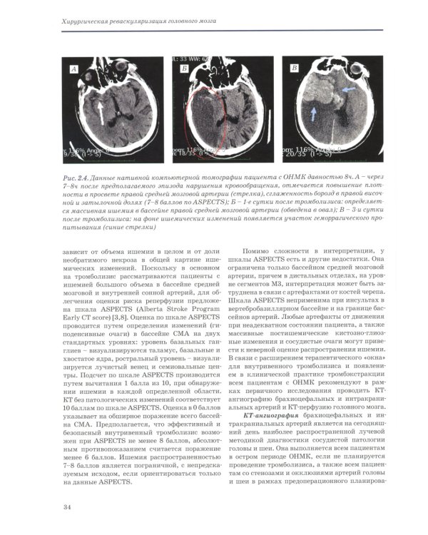 Хирургическая реваскуляризация головного мозга