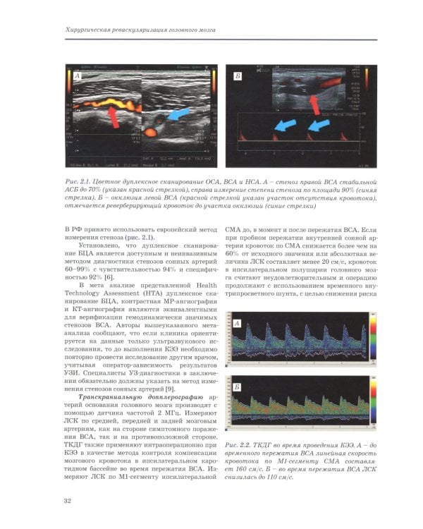 Хирургическая реваскуляризация головного мозга