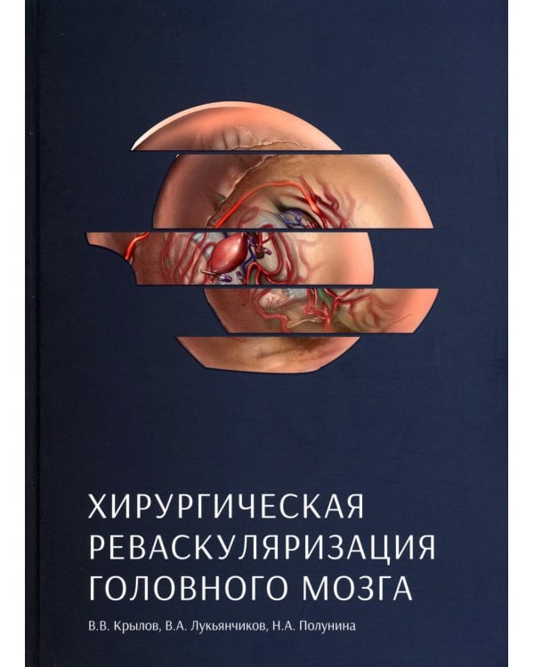 Хирургическая реваскуляризация головного мозга