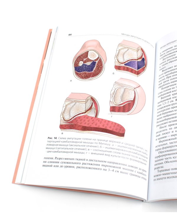Высокие ампутации нижних конечностей при гангрене: Учебное пособие