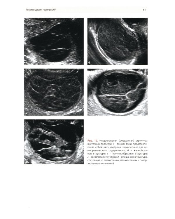 Стандартизация ультразвукового исследования патологии придатков матки по IOTA, O-RADS. Методические рекомендации. 3-е изд., доп