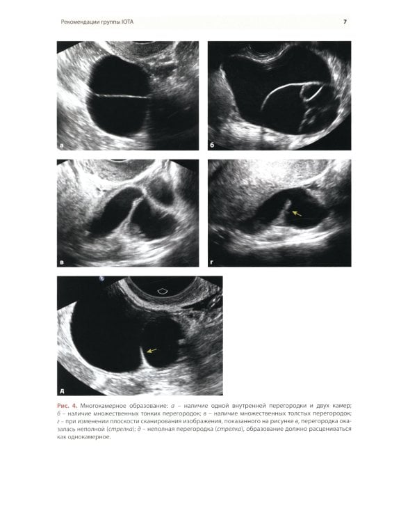 Стандартизация ультразвукового исследования патологии придатков матки по IOTA, O-RADS. Методические рекомендации. 3-е изд., доп