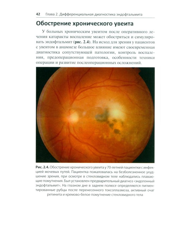 Эндофтальмит в клинической практике