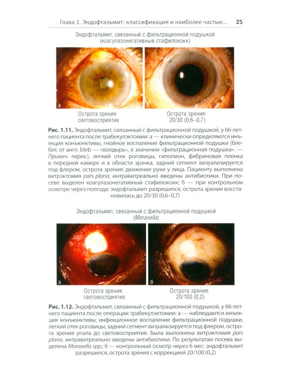 Эндофтальмит в клинической практике