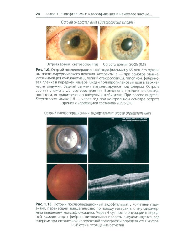 Эндофтальмит в клинической практике
