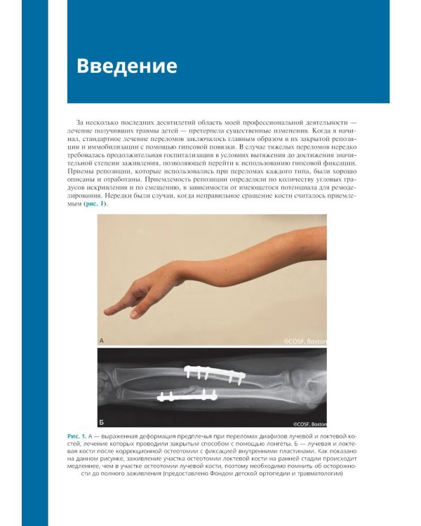 Хирургическое лечение переломов у детей. Иллюстрированные рекомендации