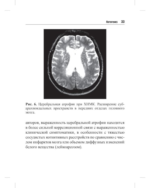 Хроническая цереброваскулярная недостаточность. 4-е изд., перераб.и доп