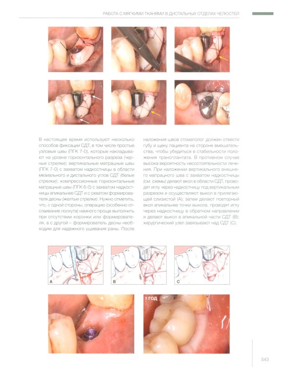 Пластическая хирургия мягких тканей в области имплантов. В 2 т