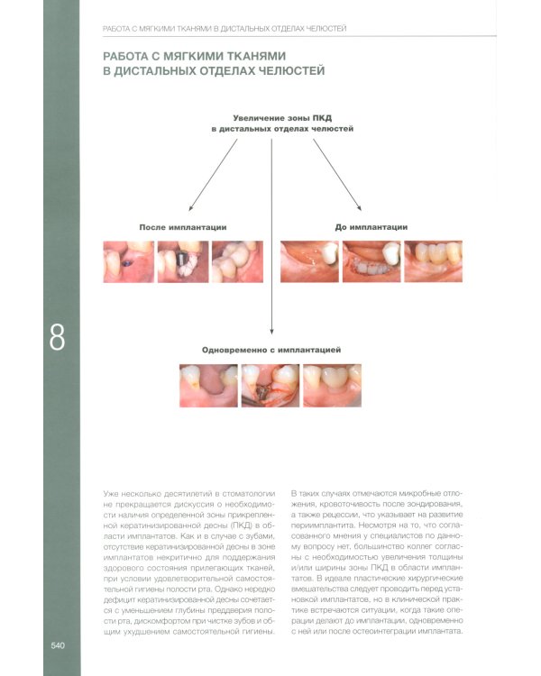 Пластическая хирургия мягких тканей в области имплантов. В 2 т
