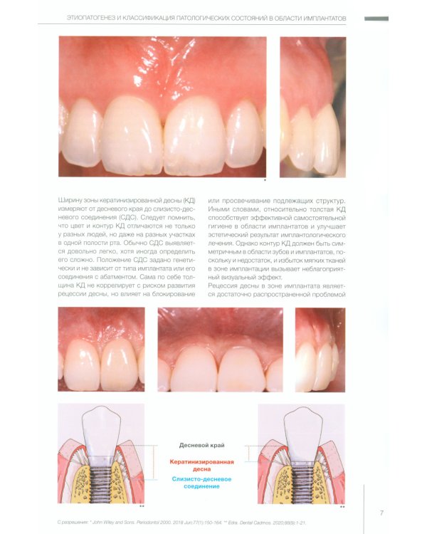 Пластическая хирургия мягких тканей в области имплантов. В 2 т