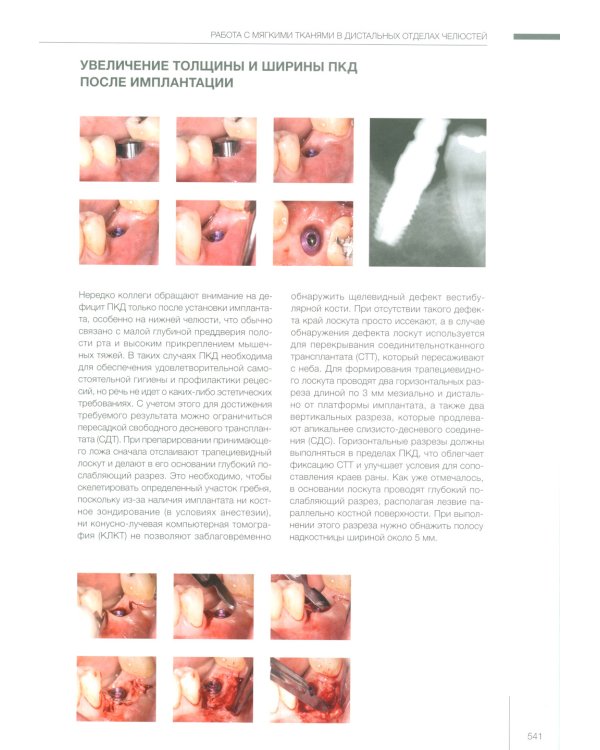Пластическая хирургия мягких тканей в области имплантов. В 2 т