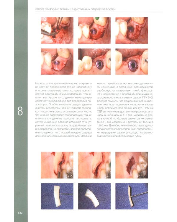 Пластическая хирургия мягких тканей в области имплантов. В 2 т