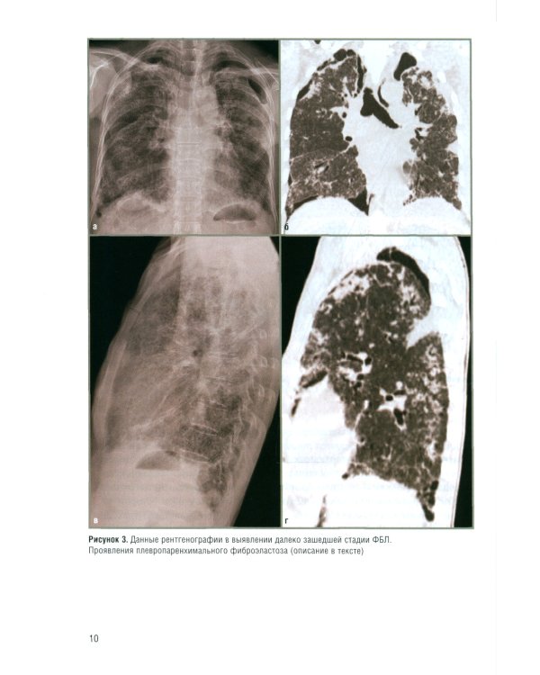 Фиброзирующие болезни легких. Роль рентгенолога в мультидисциплинарном консилиуме