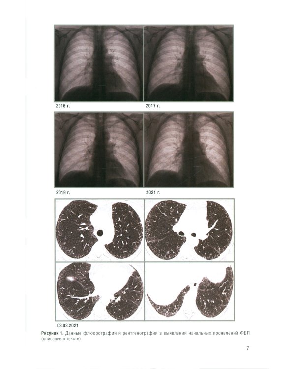 Фиброзирующие болезни легких. Роль рентгенолога в мультидисциплинарном консилиуме