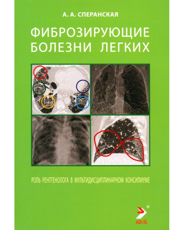 Фиброзирующие болезни легких. Роль рентгенолога в мультидисциплинарном консилиуме