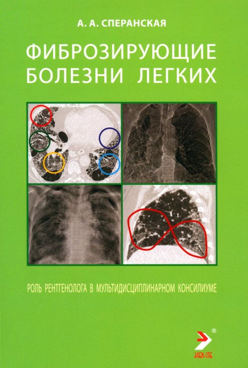 Фиброзирующие болезни легких. Роль рентгенолога в мультидисциплинарном консилиуме Фиброзирующие болезни легких. Роль рентгенолога в мультидисциплинарном консилиуме