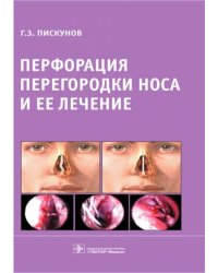 Перфорация перегородки носа и ее лечение