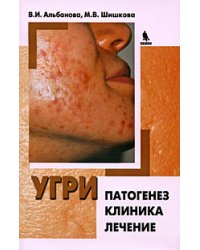 Угри. Патогенез. Клиника. Лечение